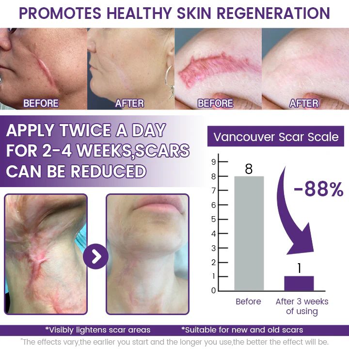 Timilk Regenscar Stem Cell Scar Gel 20g Triple Action Formula For Old And New Scars Surgical Marks Skin Renewal Timilk Regenscar Stem Cell Scar Gel 20g Triple Action Formula For Old And New Scars Surgical Marks Skin Renewal